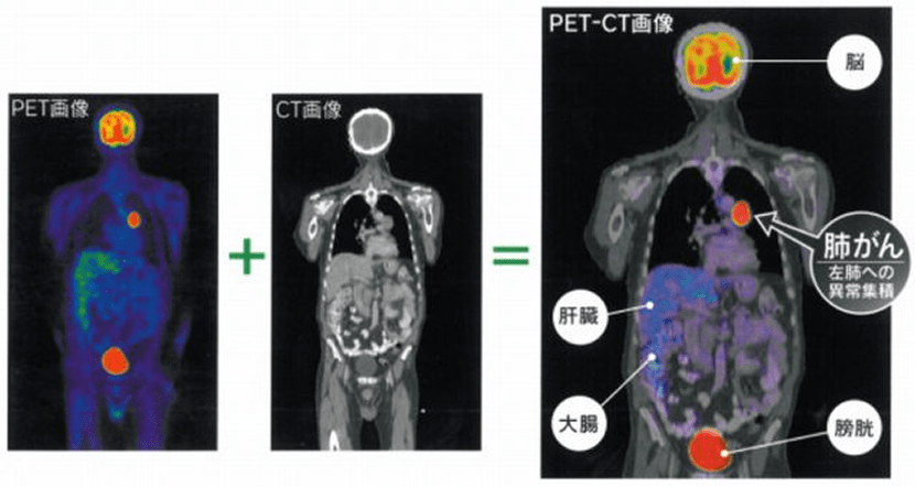PET-CT検査結果の画像例